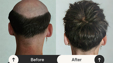 Best Adhesive for Lace, Skin, and Poly Hair System Bases