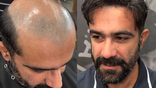 Would A Celebrity Suffer from Hair Loss?
