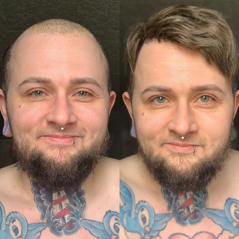 Ares Men's Non Surgical Hair Replacement | French Lace With Skin Around | Best for Daily Wear