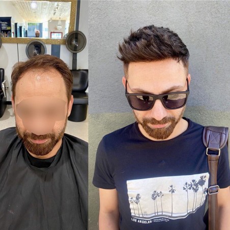 Helios Hair System for Bald Men |Full Swiss Lace Base |Best for Summer Helios Hair System for Bald Men |Full Swiss Lace Base |Best for Summer
