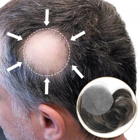 Side/Back Hair Patches for Men | Covering Bald Spots on Head Sides or Back