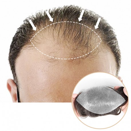 Heavy Receding Hairline Patch | Covering Receding Hairline and Head Top