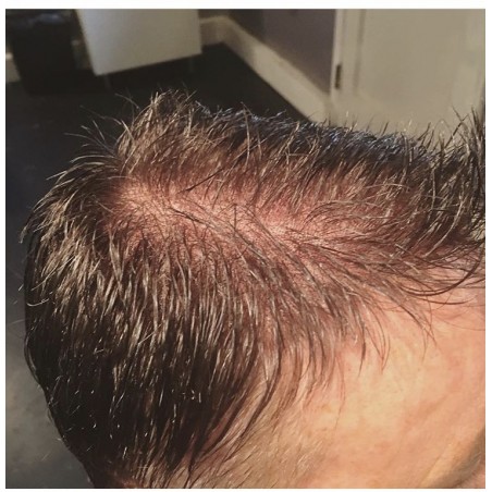 Custom Made Men's Hair System Custom Made Men's Hair System