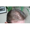 Custom Made Men's Hair System Custom Made Men's Hair System