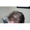 Custom Made Men's Hair System Custom Made Men's Hair System