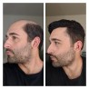 Mirage Toupee for Men |Full Super Thin Skin Base |Celebrities Choice Mirage Toupee for Men |Full Super Thin Skin Base |Celebrities Choice