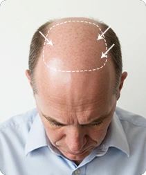 Toupee