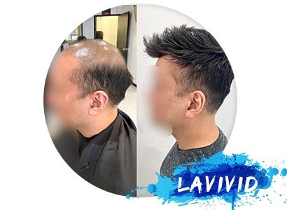 Have You Tried the Best Solution for Male Pattern Baldness?