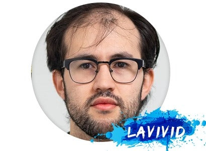 How to Choose A Hair Loss Solution for Male?