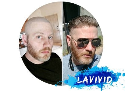 All You Need to Know About Lavivid Hair Transplant Systems – LaVivid Hair