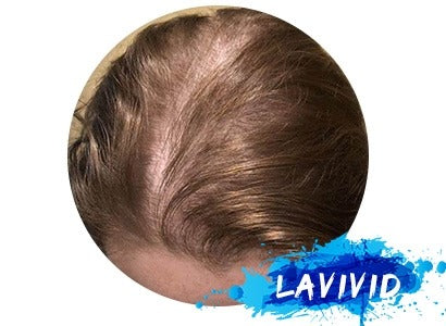 What Causes Women’s Thinning Hair?