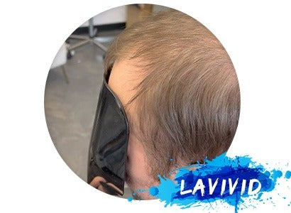 Hair System Review - LAVivid Helios Hair System - BEST Solution to Male Pattern Hair Loss