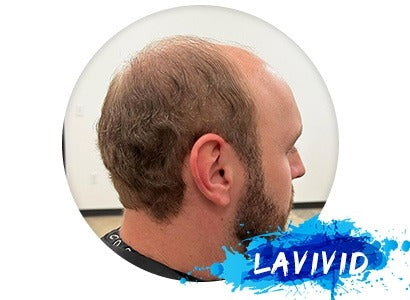 Hair System 101 - How to Take the Weekly Maintenance of Your Hair Replacement System