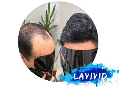 The Ultimate Guide to Choosing the Best Hair Patch for Men