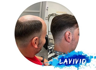 Changing Lives: A Personal Journey from Hair Loss to Renewed Confidence