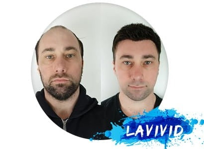 Mirage by LAVIVID: Redefining Men’s Hair Loss Solutions with Customized Elegance