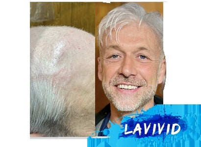 Choosing Courage: A Definitive Guide to Hair Replacement for Cancer Warriors