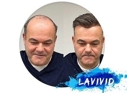 Accepting Solutions: Wigs to Address Male Hair Loss