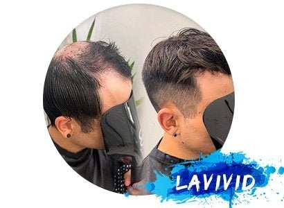 Alopecia Areata Awareness Month: Embrace Confidence with Our Exclusive Hair Patch Sale