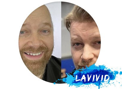 Hair Loss, Mental Health, and How Hair Systems Changed My Life