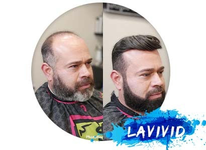 Hair Systems For Men: A Guide To Non-Surgical Hair Replacement