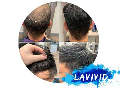 15 Best Men’s Haircuts for Balding Hair