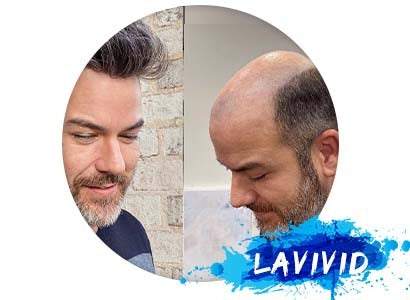 How Modern Hair Systems Work