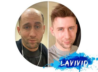 What Makes a Great Toupee and a Bad One?