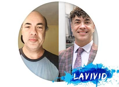 How Do The Male Celebrities Deal with Hair Loss?