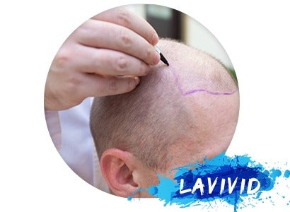 The Advantage of Hair System Compared with Drugs or Hair Transplant