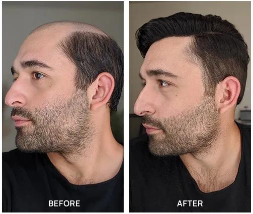 Best Hair toupee ever