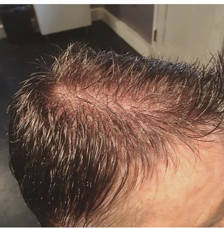 Custom Made Men's Hair System