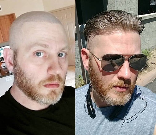 Helios hair system