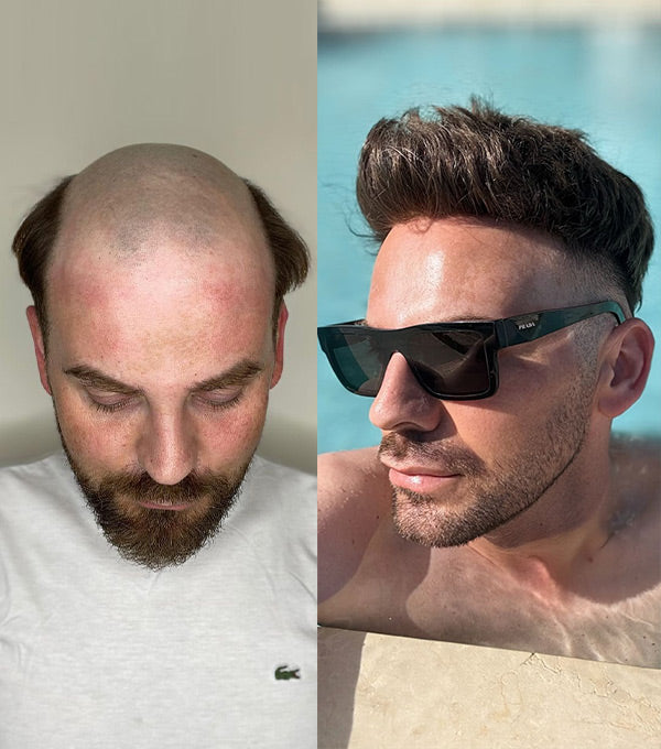 Tyler| Seamless Lace Hairline
