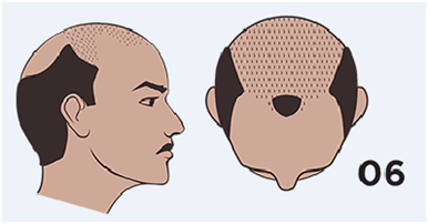 thin hair male