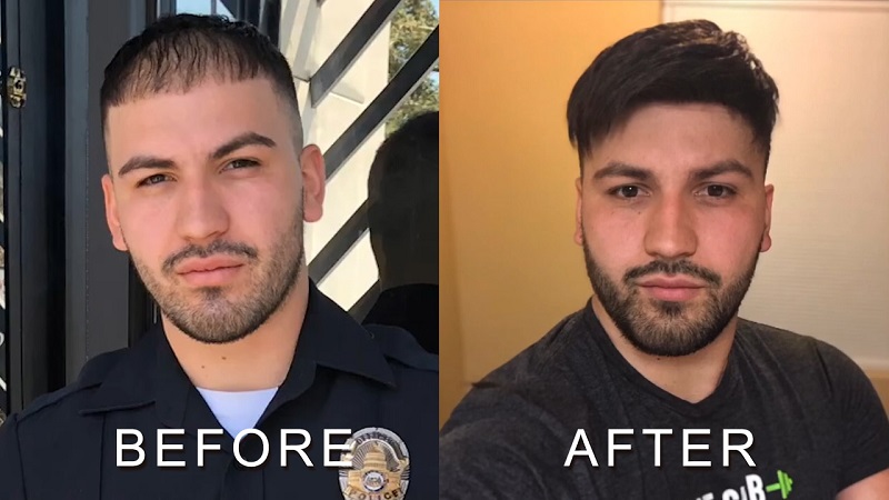 men's hair density