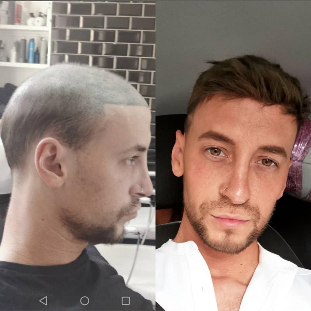 hair replacement toupee