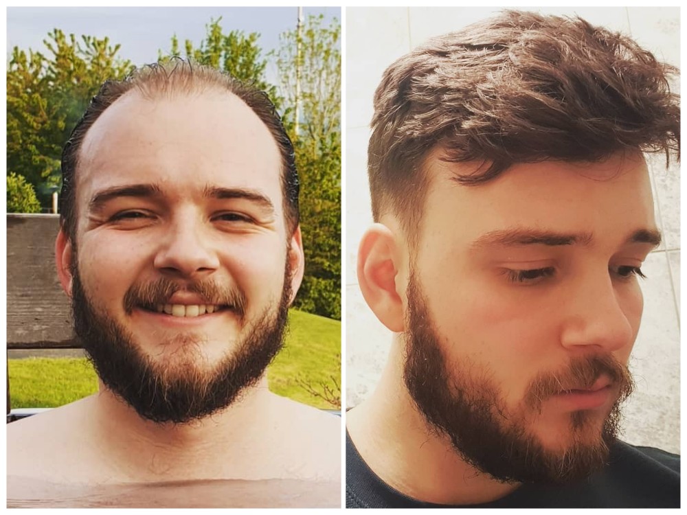 What Do You Think of Bald Spot on Head Male? What Do You Think of Bald Spot on Head Male?