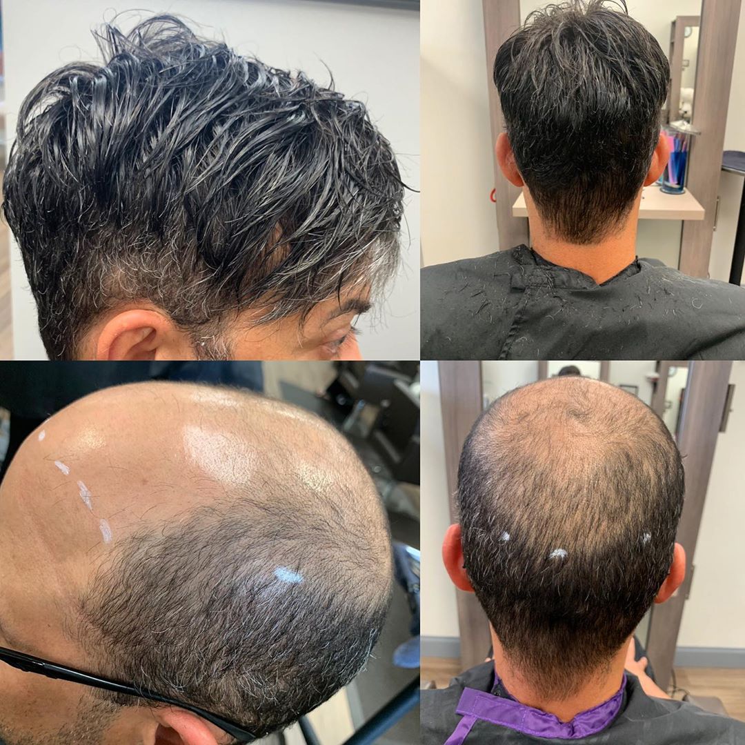 The Guide of Preventing Hair Loss on Your Crown Male