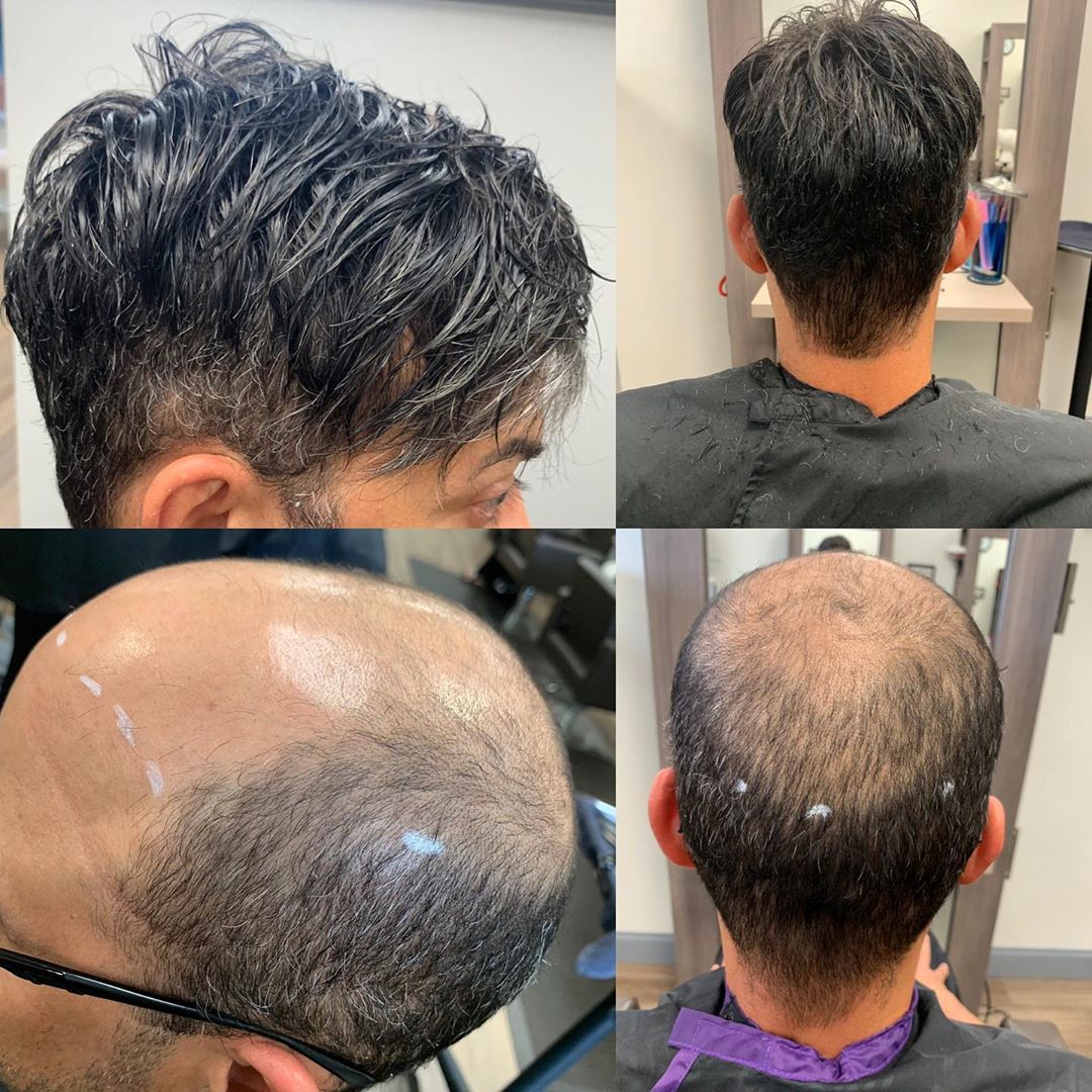 The Guide of Preventing Hair Loss on Your Crown Male The Guide of Preventing Hair Loss on Your Crown Male