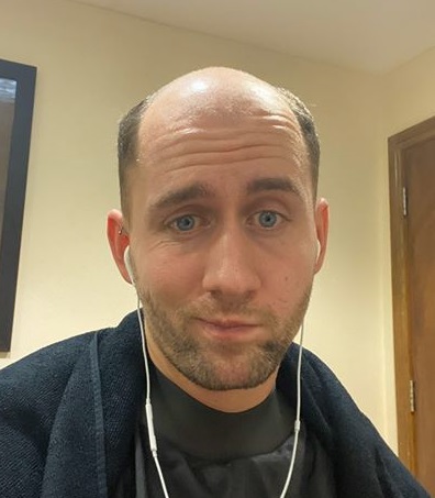 How to Solve The Male Hair Crown Thinning Issue? How to Solve The Male Hair Crown Thinning Issue?