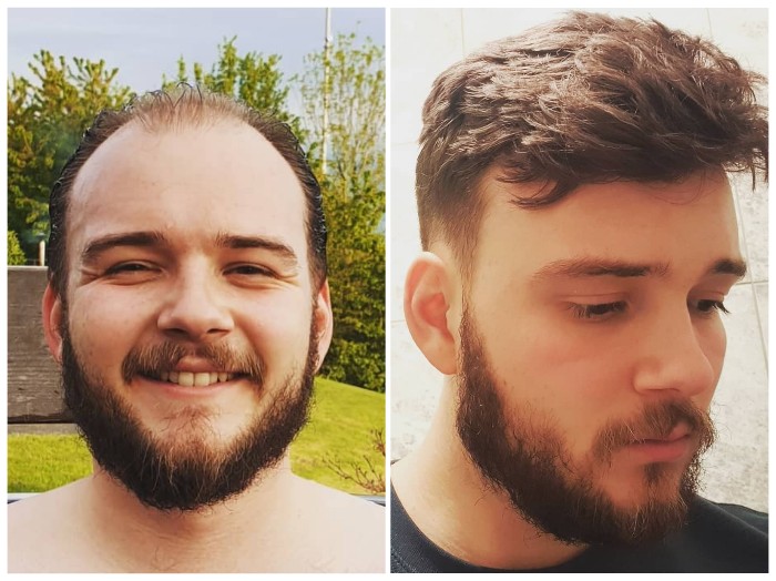 What Leds to Hair Thinning in Male? What Leds to Hair Thinning in Male?