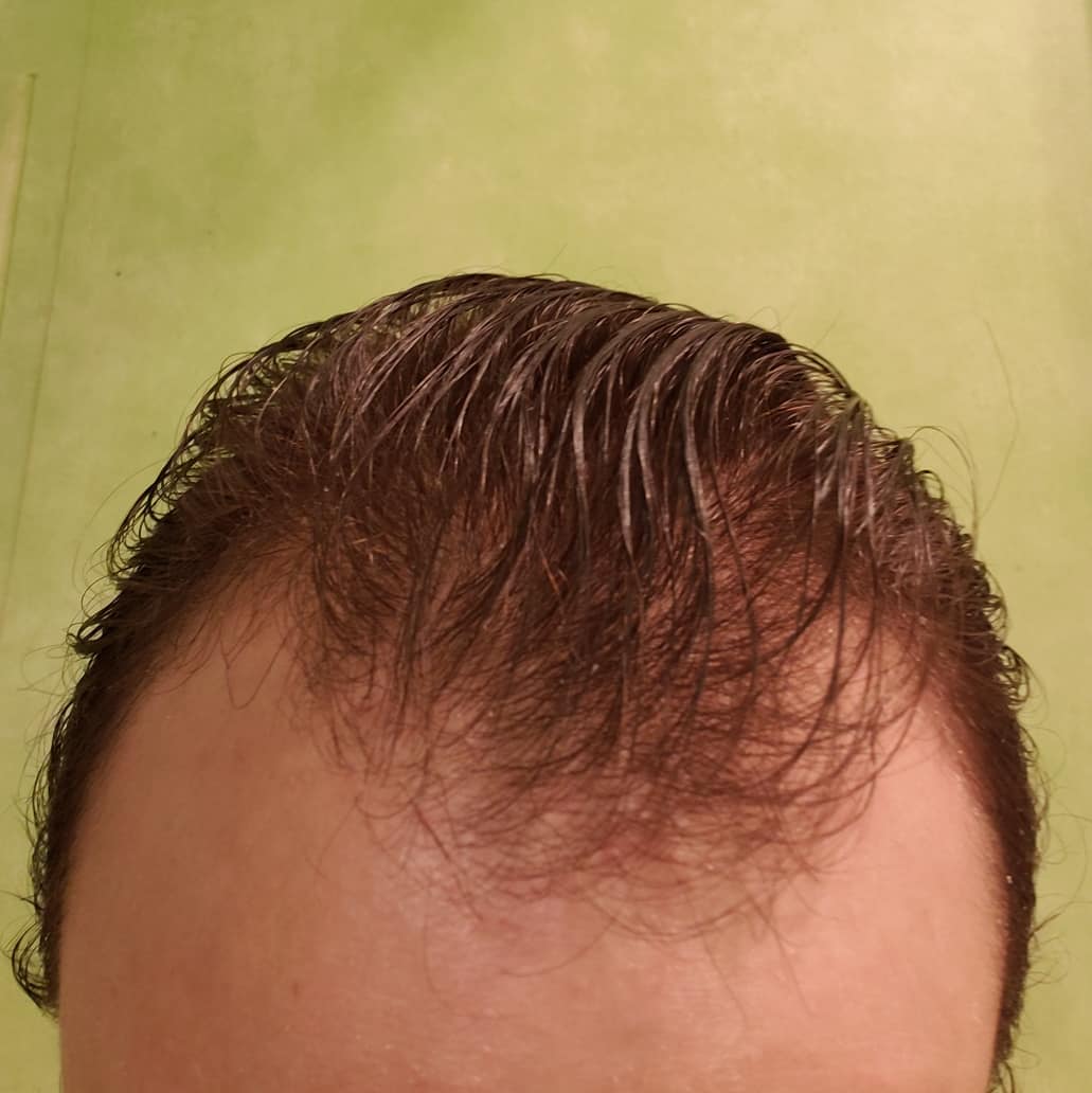The Introduce of the Major Available Men's Thinning Hair Remedies The Introduce of the Major Available Men's Thinning Hair Remedies