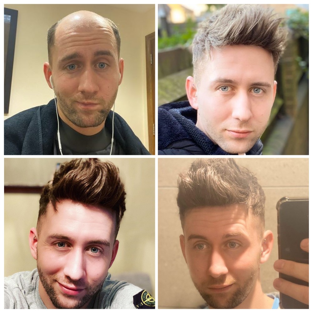 The Reason for Non-Surgical Hair Systems Are Preferred Over Hair Transplants The Reason for Non-Surgical Hair Systems Are Preferred Over Hair Transplants