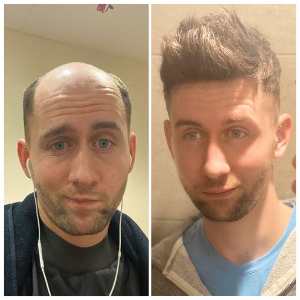 The Introduce of A Solution for Thin Hair Male