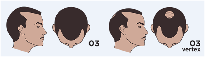 men's hair loss stage 3