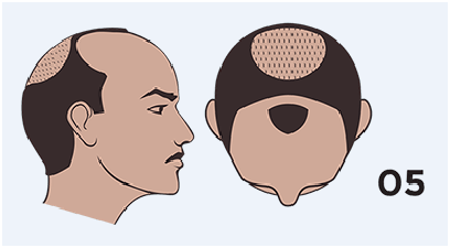 men's hair loss