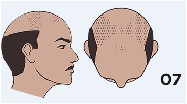 hair loss