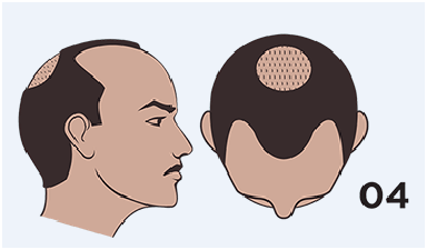 hair loss stage 4