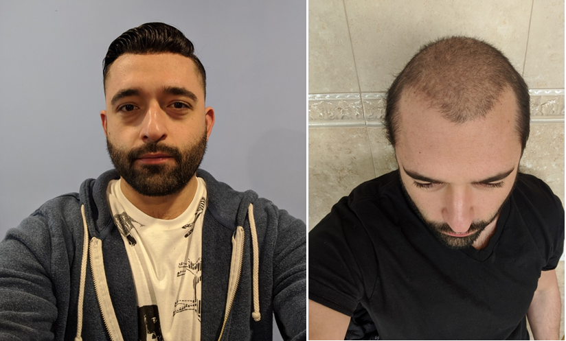 male pattern baldness